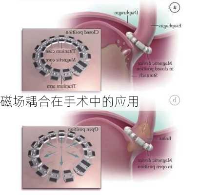 磁场耦合在手术中的应用