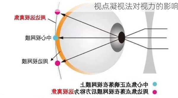 视点凝视法对视力的影响