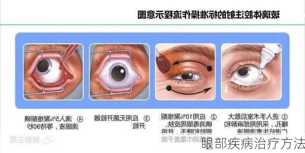 眼部疾病治疗方法