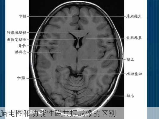 脑电图和功能性磁共振成像的区别