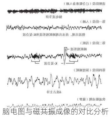 脑电图与磁共振成像的对比分析