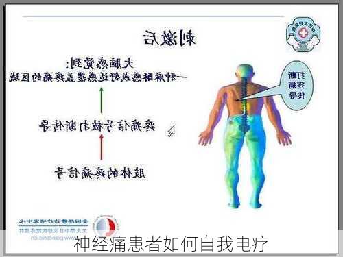 神经痛患者如何自我电疗