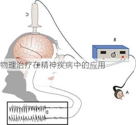 物理治疗在精神疾病中的应用