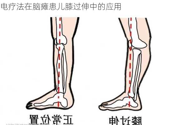 电疗法在脑瘫患儿膝过伸中的应用