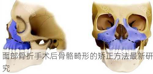 面部骨折手术后骨骼畸形的矫正方法最新研究