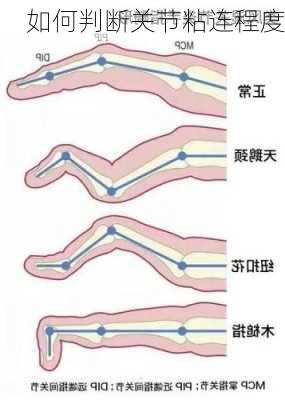 如何判断关节粘连程度