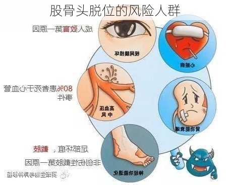 股骨头脱位的风险人群